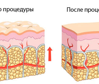 Купить аппарат для кавитации похудения